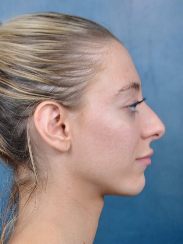 Rhinoplasty Before & After Gallery - Patient 148827492 - Image 7