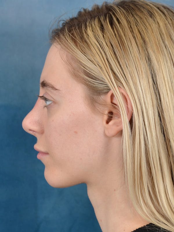 Rhinoplasty Before & After Gallery - Patient 148827492 - Image 2