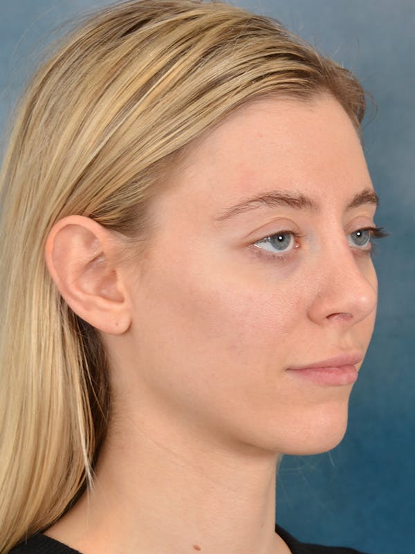 Rhinoplasty Before & After Gallery - Patient 148827492 - Image 6
