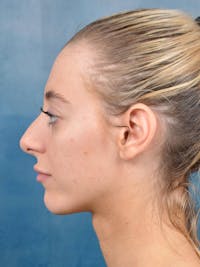 Rhinoplasty Before & After Gallery - Patient 148827492 - Image 1
