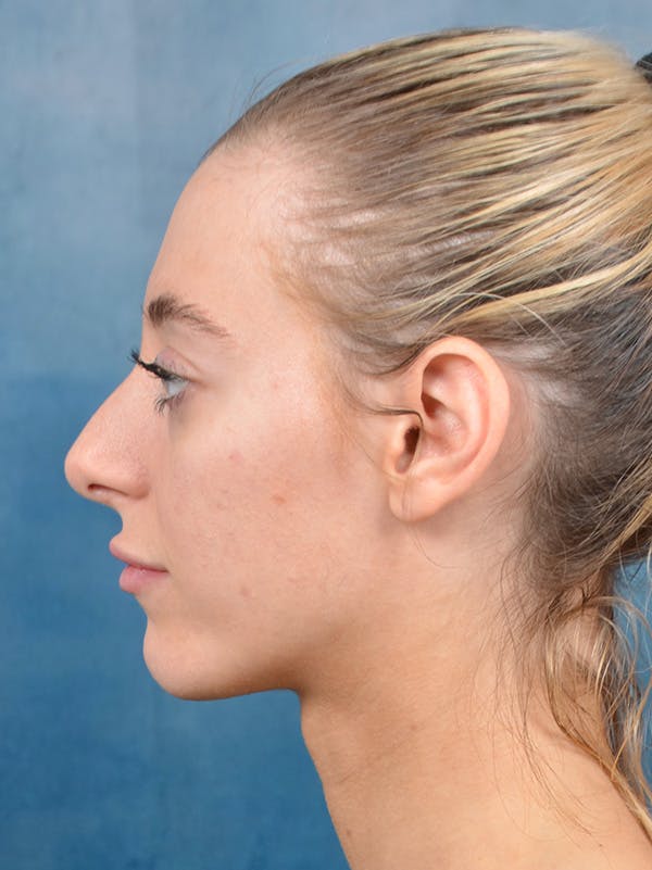 Rhinoplasty Before & After Gallery - Patient 148827492 - Image 1