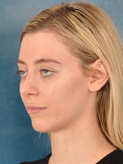 Rhinoplasty Before & After Gallery - Patient 148827492 - Image 10