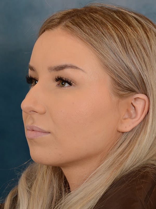 Rhinoplasty Before & After Gallery - Patient 149235923 - Image 5