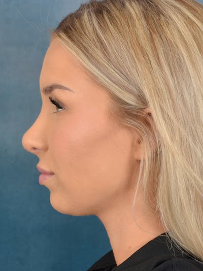 Rhinoplasty Before & After Gallery - Patient 149235923 - Image 2