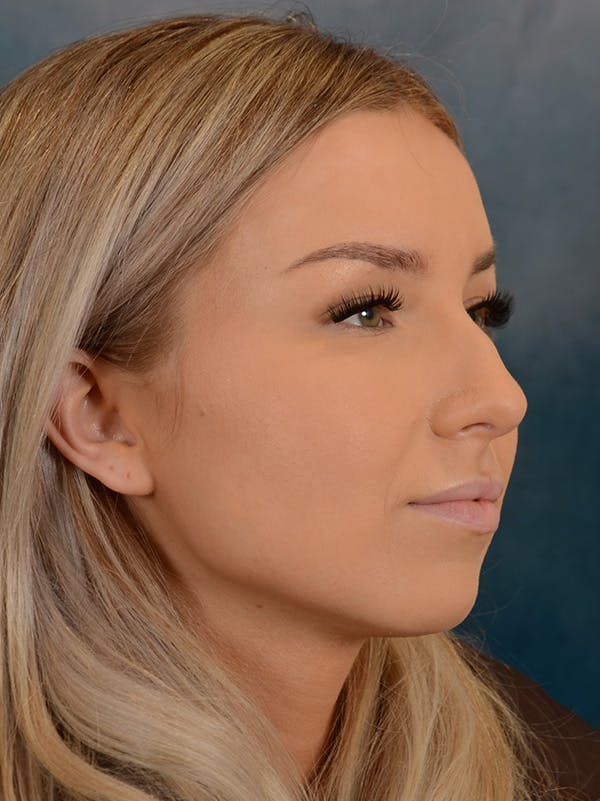 Rhinoplasty Before & After Gallery - Patient 149235923 - Image 7