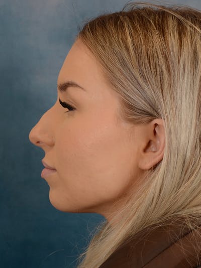 Rhinoplasty Before & After Gallery - Patient 149235923 - Image 1
