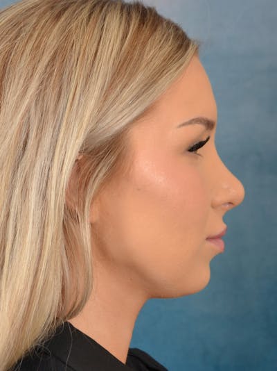 Rhinoplasty Before & After Gallery - Patient 149235923 - Image 10