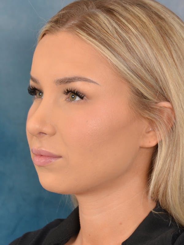 Rhinoplasty Before & After Gallery - Patient 149235923 - Image 6