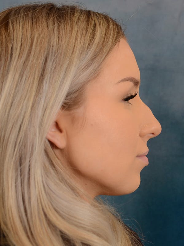 Rhinoplasty Before & After Gallery - Patient 149235923 - Image 9