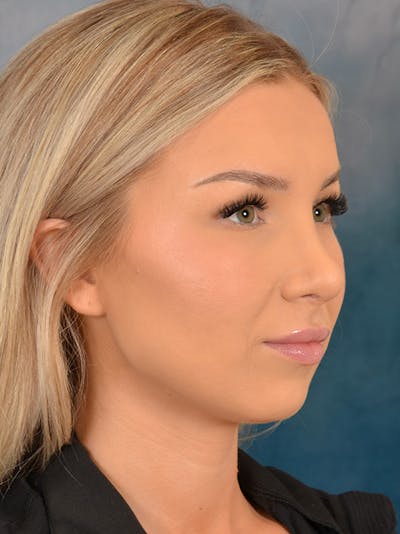 Rhinoplasty Before & After Gallery - Patient 149235923 - Image 8