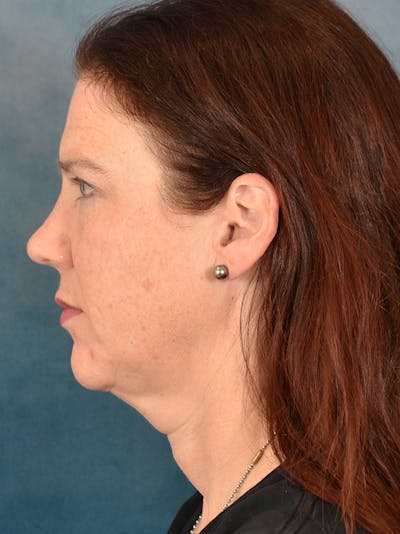 Rhinoplasty Before & After Gallery - Patient 149235919 - Image 2