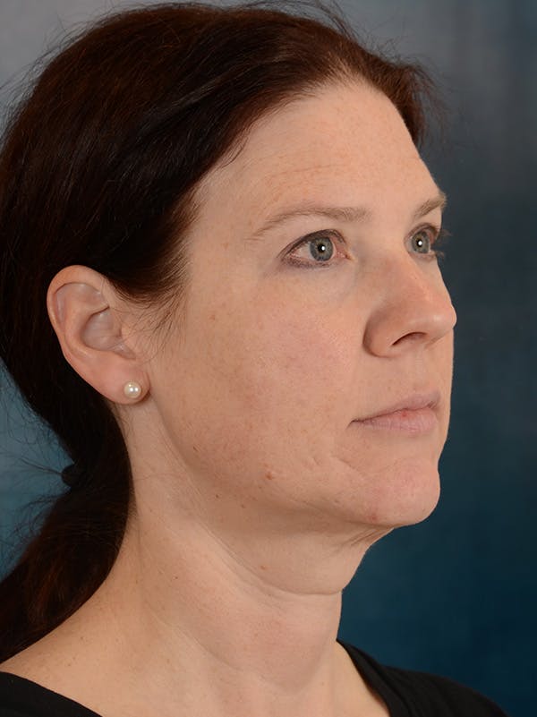 Rhinoplasty Before & After Gallery - Patient 149235919 - Image 7