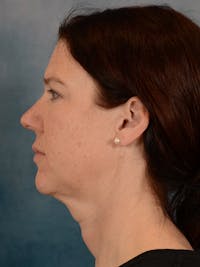 Rhinoplasty Before & After Gallery - Patient 149235919 - Image 1