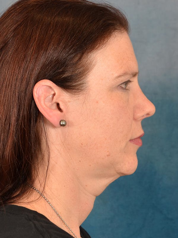 Rhinoplasty Before & After Gallery - Patient 149235919 - Image 10