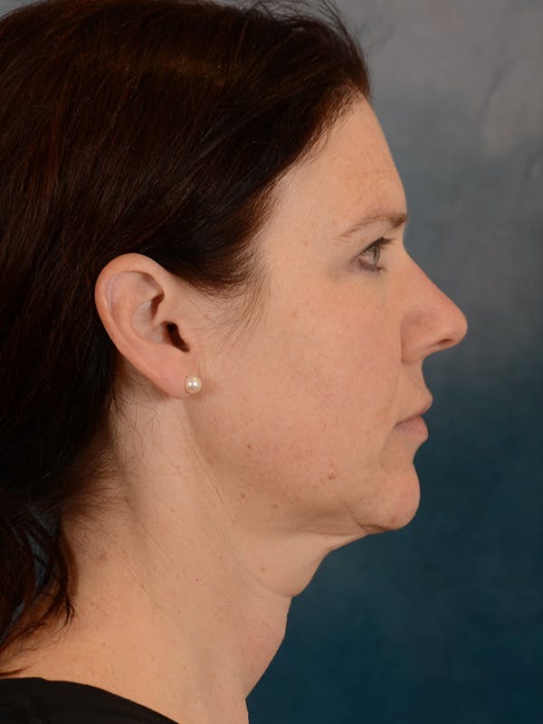 Rhinoplasty Before & After Gallery - Patient 149235919 - Image 9