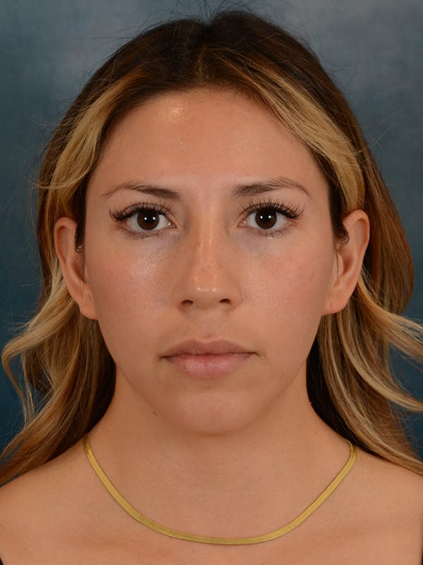 Rhinoplasty Before & After Gallery - Patient 149235925 - Image 3