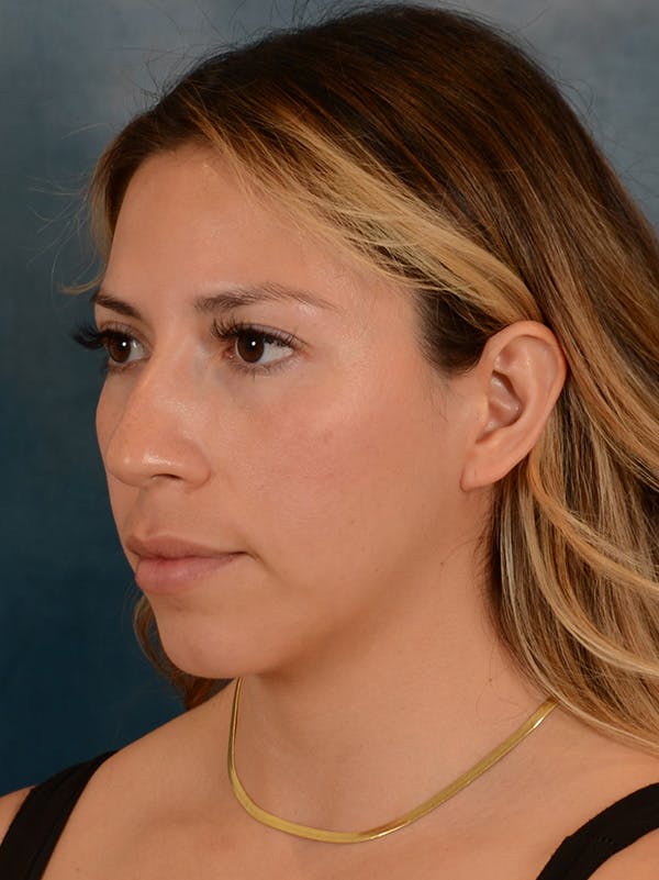 Rhinoplasty Before & After Gallery - Patient 149235925 - Image 5
