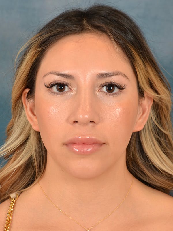 Rhinoplasty Before & After Gallery - Patient 149235925 - Image 4