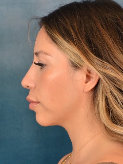 Rhinoplasty Before & After Gallery - Patient 149235925 - Image 2