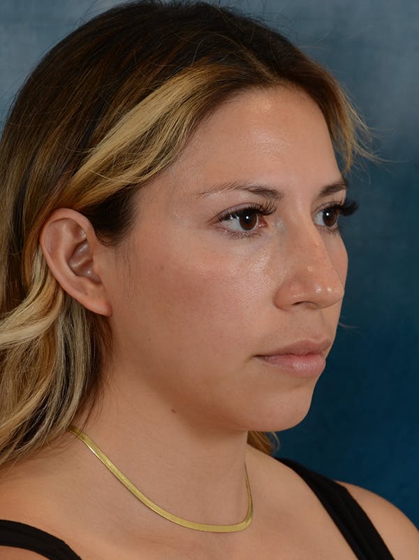 Rhinoplasty Before & After Gallery - Patient 149235925 - Image 7