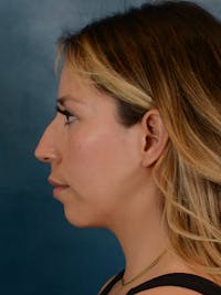 Rhinoplasty Before & After Gallery - Patient 149235925 - Image 1
