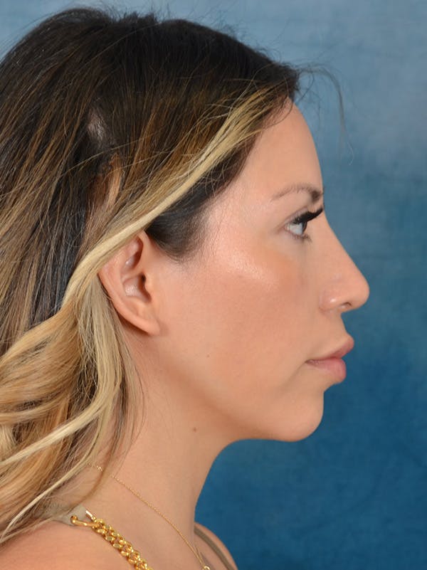 Rhinoplasty Before & After Gallery - Patient 149235925 - Image 10