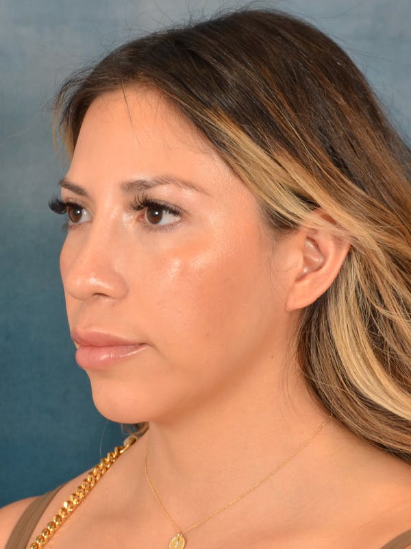 Rhinoplasty Before & After Gallery - Patient 149235925 - Image 6