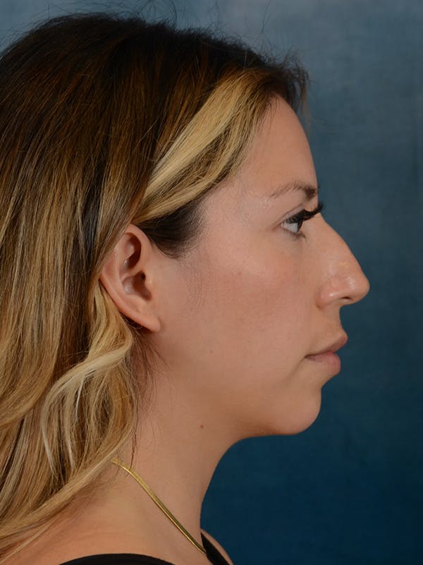 Rhinoplasty Before & After Gallery - Patient 149235925 - Image 9
