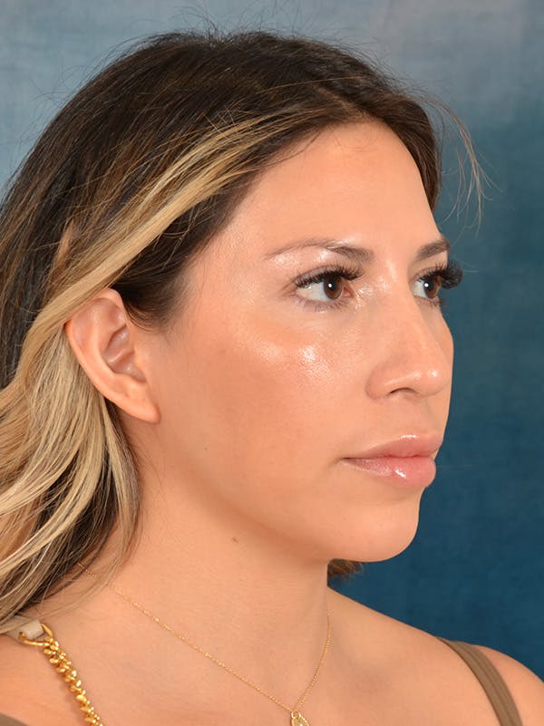 Rhinoplasty Before & After Gallery - Patient 149235925 - Image 8