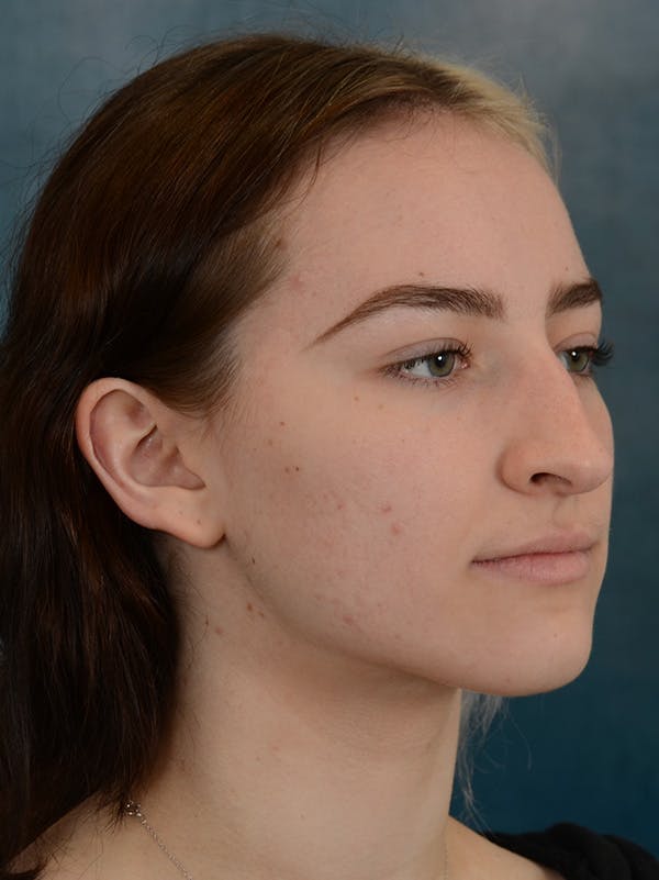 Rhinoplasty Before & After Gallery - Patient 149235932 - Image 5