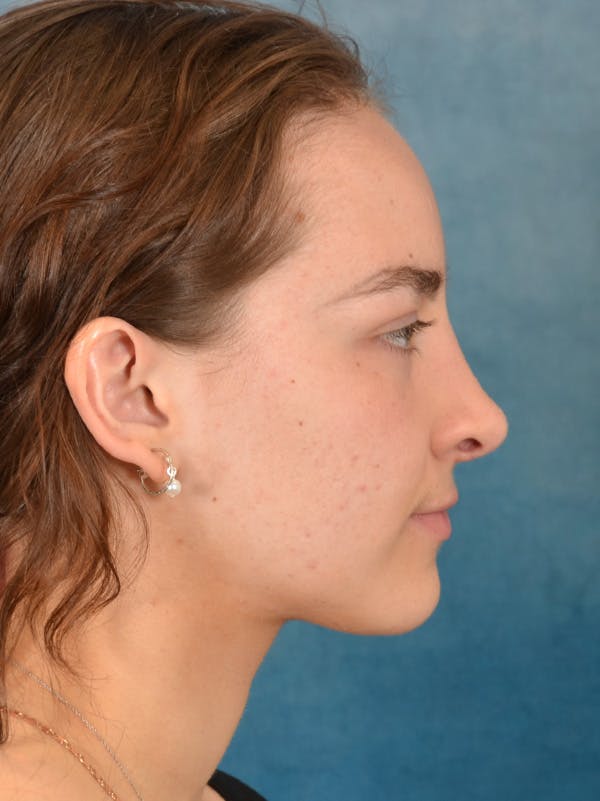 Rhinoplasty Before & After Gallery - Patient 149235932 - Image 8