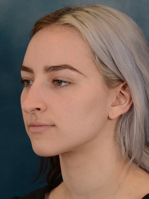 Rhinoplasty Before & After Gallery - Patient 149235932 - Image 9