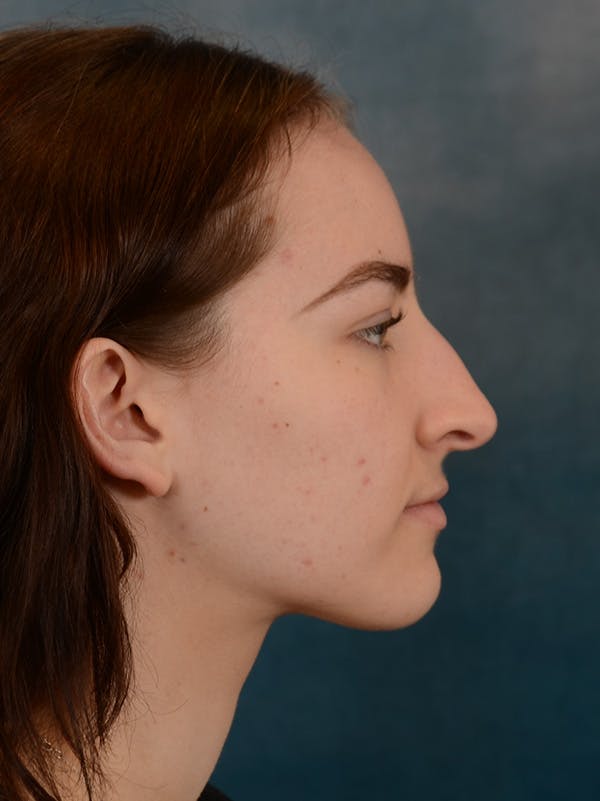 Rhinoplasty Before & After Gallery - Patient 149235932 - Image 7