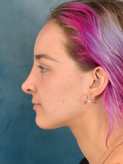 Rhinoplasty Before & After Gallery - Patient 149235932 - Image 2