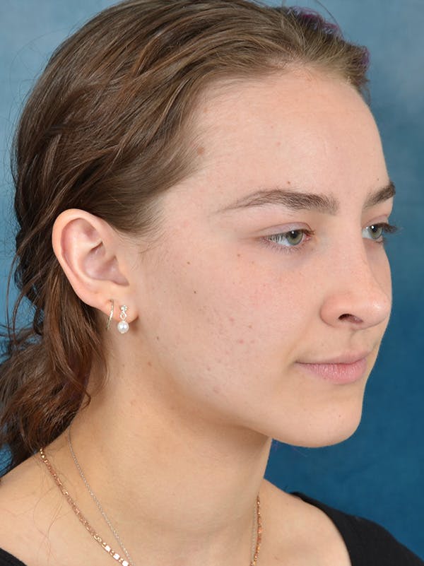 Rhinoplasty Before & After Gallery - Patient 149235932 - Image 6