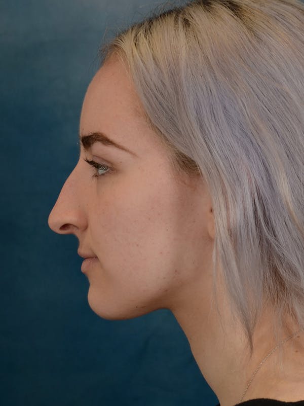 Rhinoplasty Before & After Gallery - Patient 149235932 - Image 1