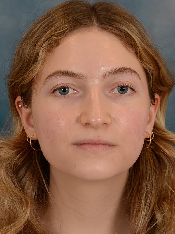 Rhinoplasty Before & After Gallery - Patient 149235929 - Image 3