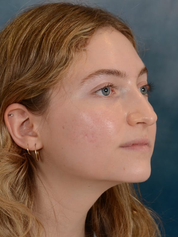 Rhinoplasty Before & After Gallery - Patient 149235929 - Image 5