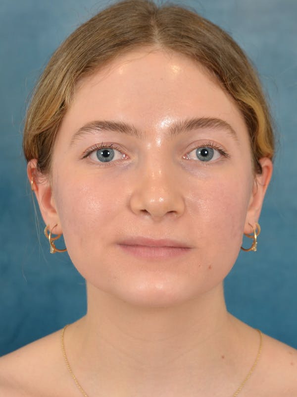 Rhinoplasty Before & After Gallery - Patient 149235929 - Image 4