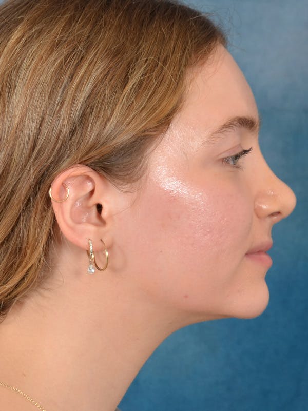 Rhinoplasty Before & After Gallery - Patient 149235929 - Image 8