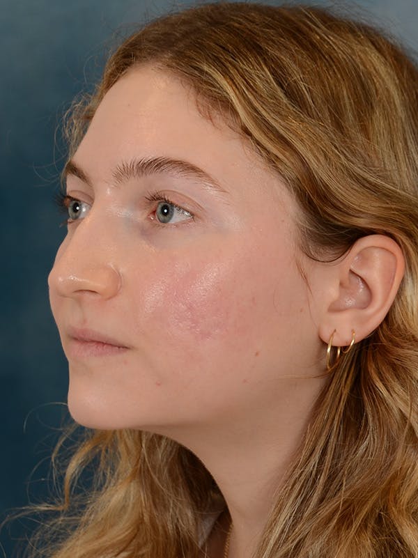 Rhinoplasty Before & After Gallery - Patient 149235929 - Image 9