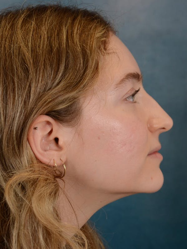 Rhinoplasty Before & After Gallery - Patient 149235929 - Image 7