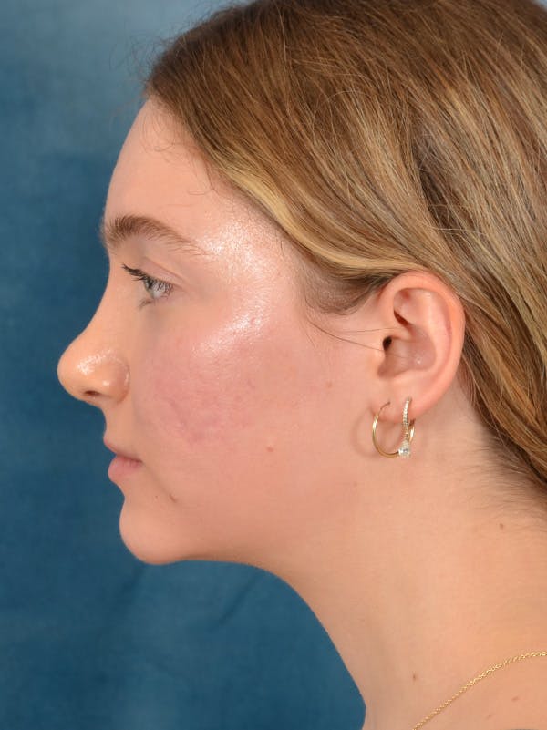 Rhinoplasty Before & After Gallery - Patient 149235929 - Image 2