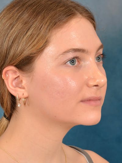 Rhinoplasty Before & After Gallery - Patient 149235929 - Image 6