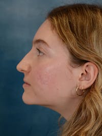 Rhinoplasty Before & After Gallery - Patient 149235929 - Image 1