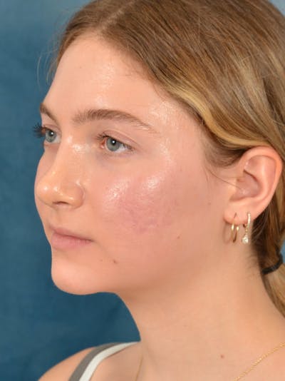 Rhinoplasty Before & After Gallery - Patient 149235929 - Image 10