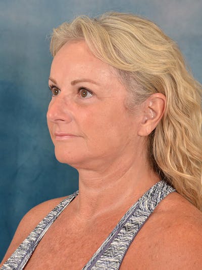 Deep Plane Facelift Before & After Gallery - Patient 158443135 - Image 2