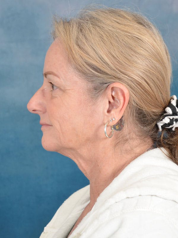 Deep Plane Facelift Before & After Gallery - Patient 158443135 - Image 3