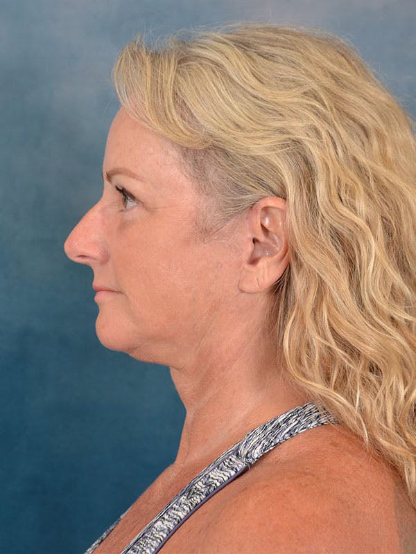 Deep Plane Facelift Before & After Gallery - Patient 158443135 - Image 4