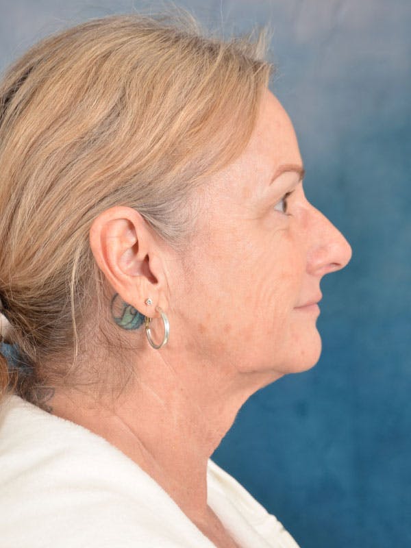 Deep Plane Facelift Before & After Gallery - Patient 158443135 - Image 5